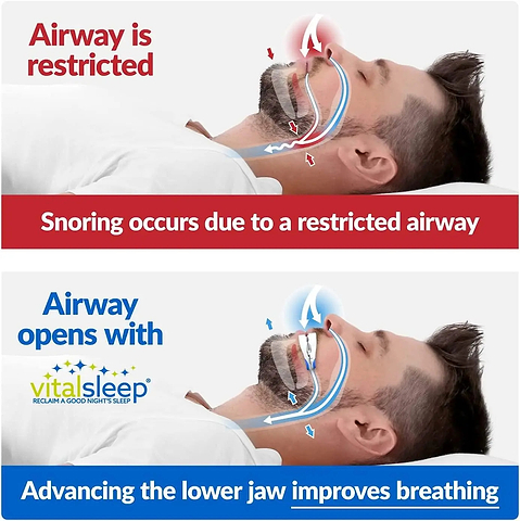 Anti snoring oral appliance for home use