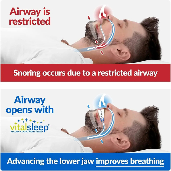Anti snoring oral appliance for home use