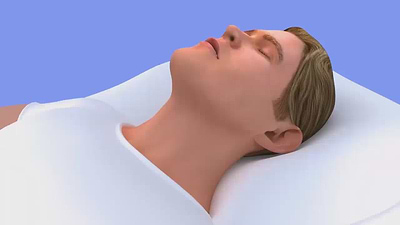 Man sleeping quietly with open airway after using an anti-snoring mouthpiece