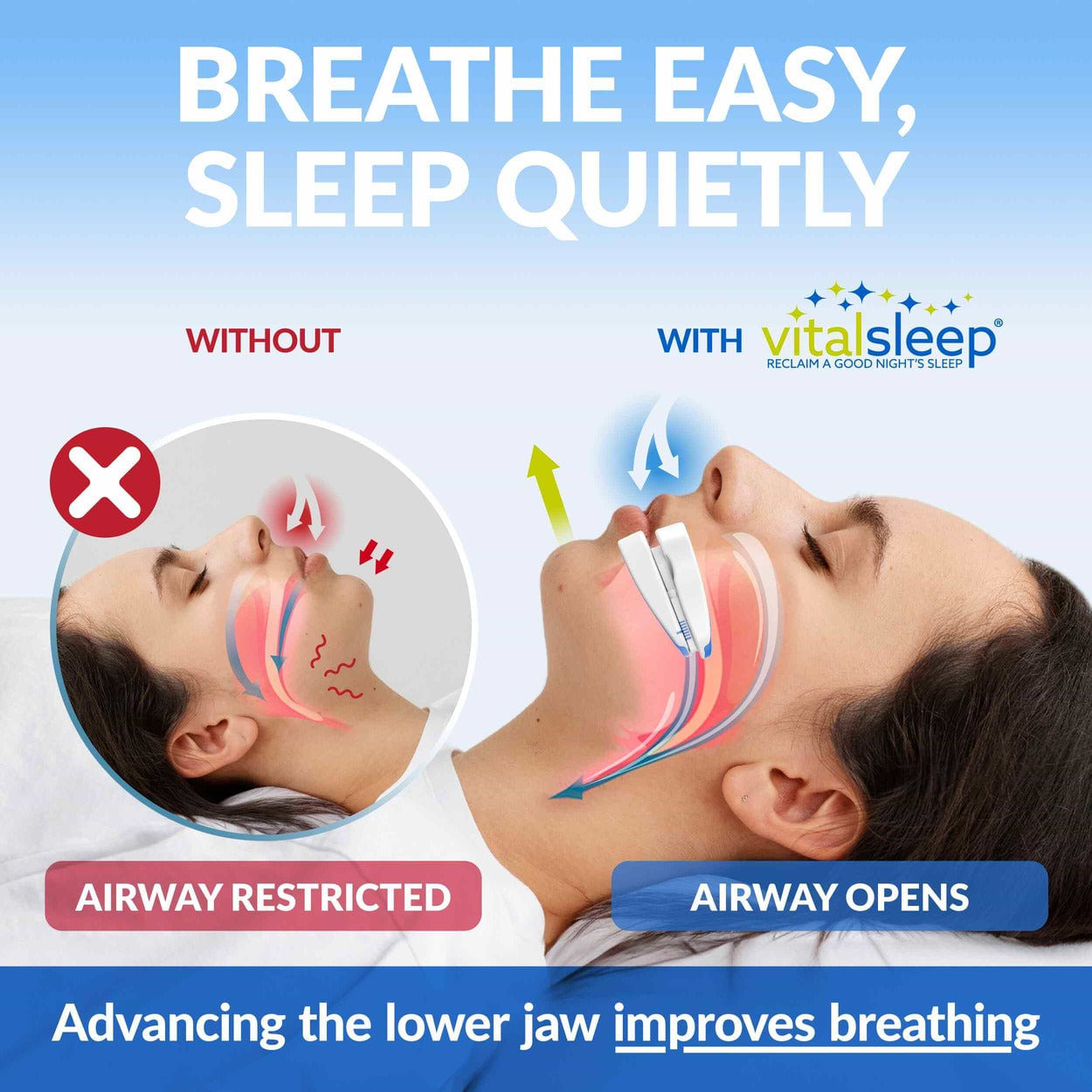 Oral appliance designed for better airflow