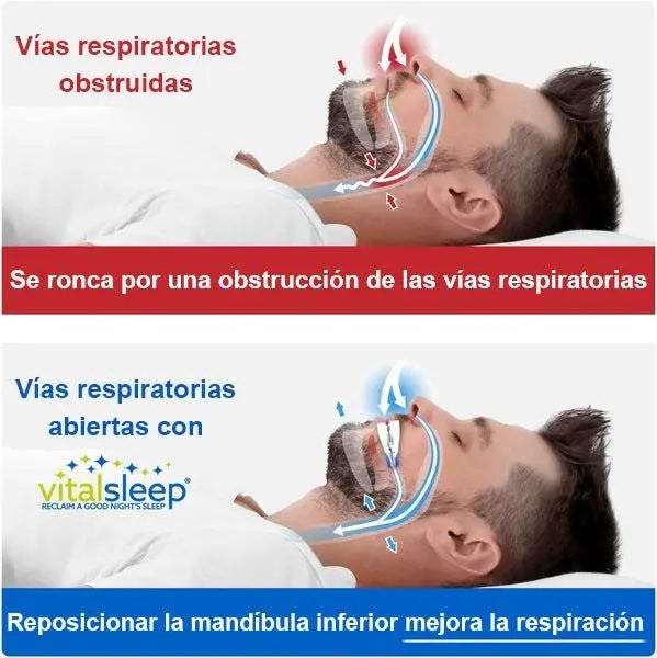Aparato bucal para reducir ronquidos