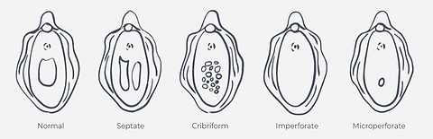 Hymen anatomy