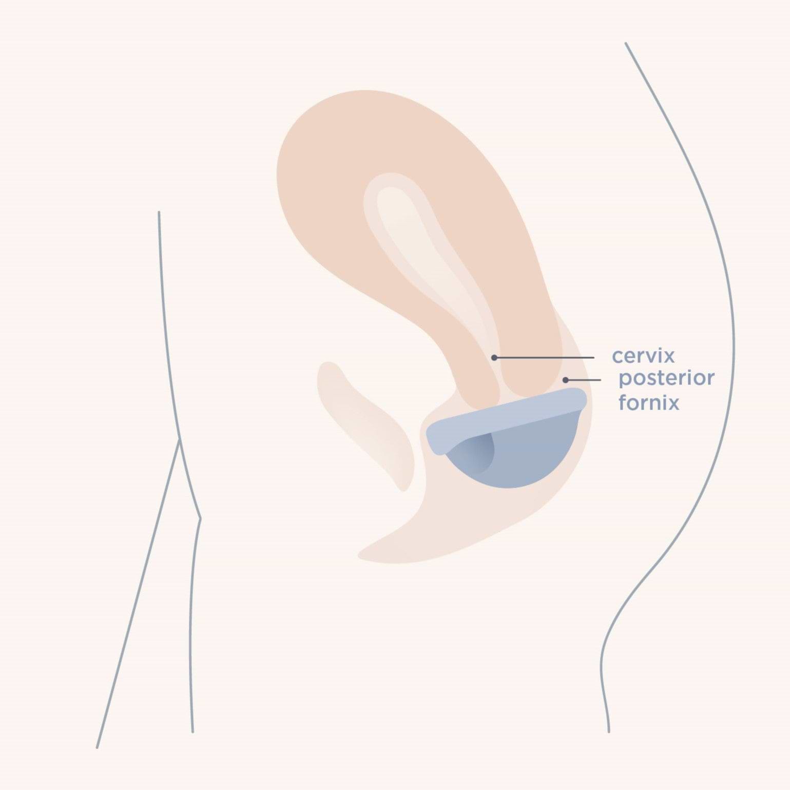 Sits in the fornix directly under the cervix disc placement