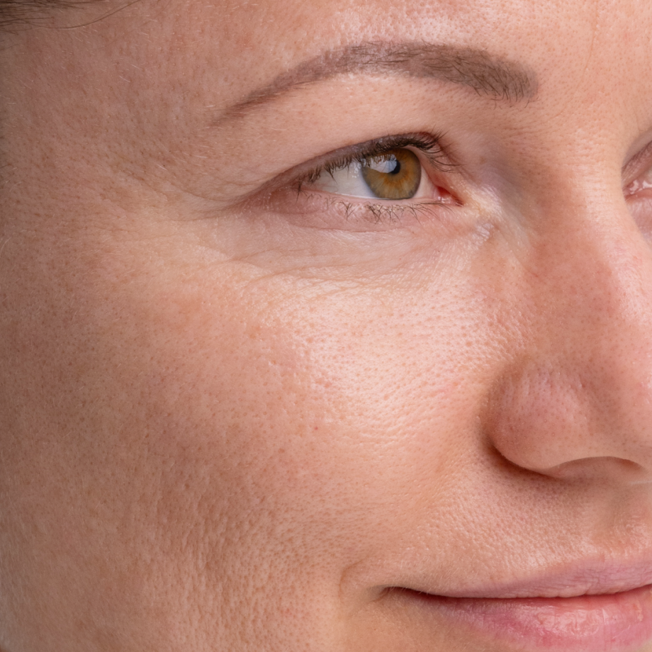 close-up of womans face before using Madara Kojic Alternative Pigment Serum