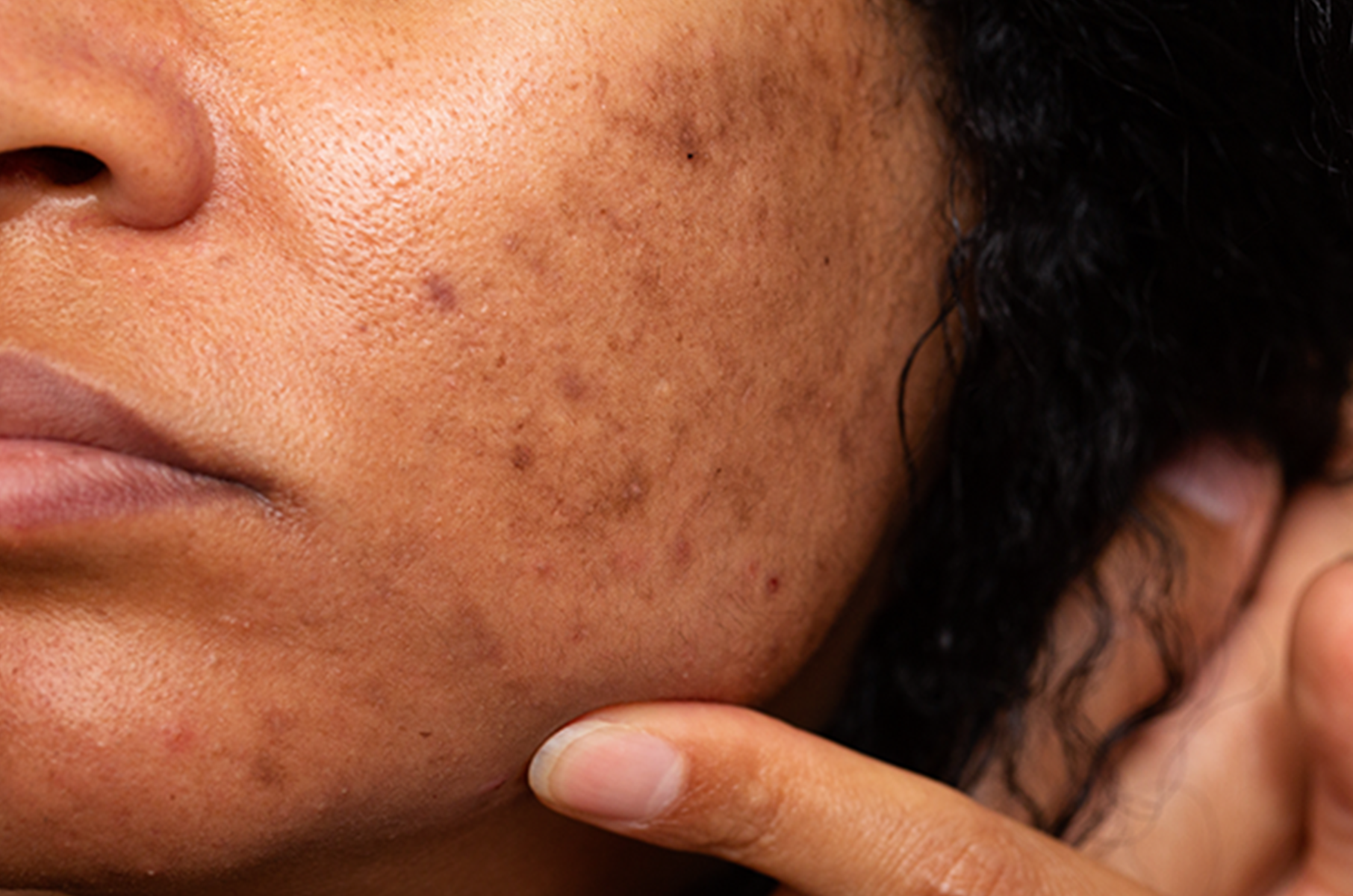 What Is Thiamidol (Isobutylamido Thiazolyl Resorcinol)—and Why It’s the Future of Pigmentation Treatment