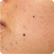 Pigmentation