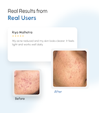 Multi-Action Acne Defense Face Serum