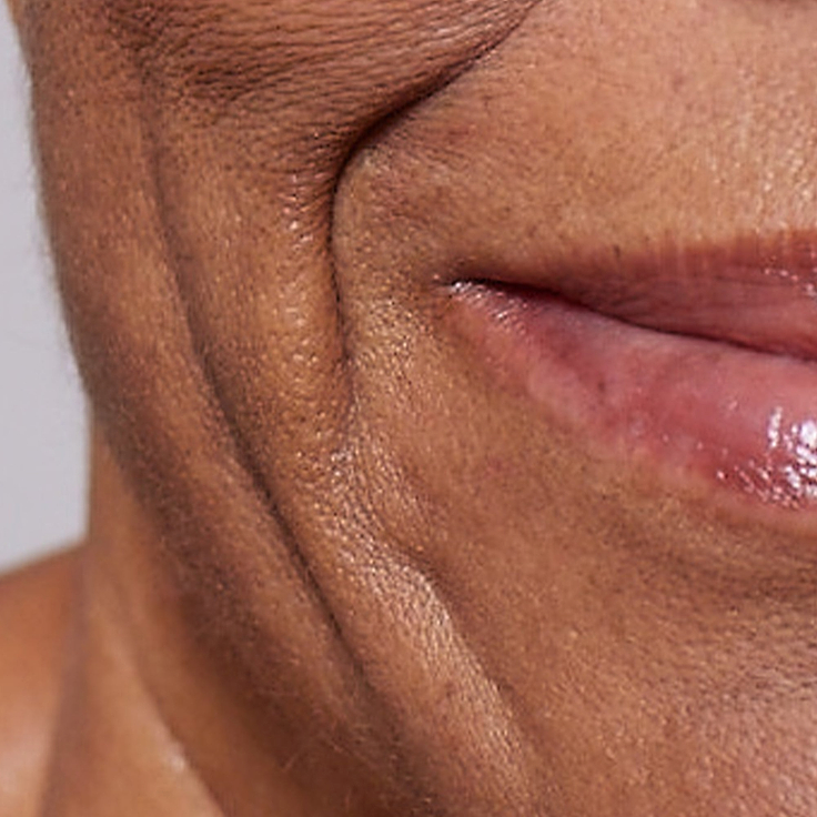 A detailed close-up photograph illustrating a visible lack of skin firmness and elasticity around a person's mouth and jawline. Below the image, clear text identifies this skin concern as 'Firmness'.
