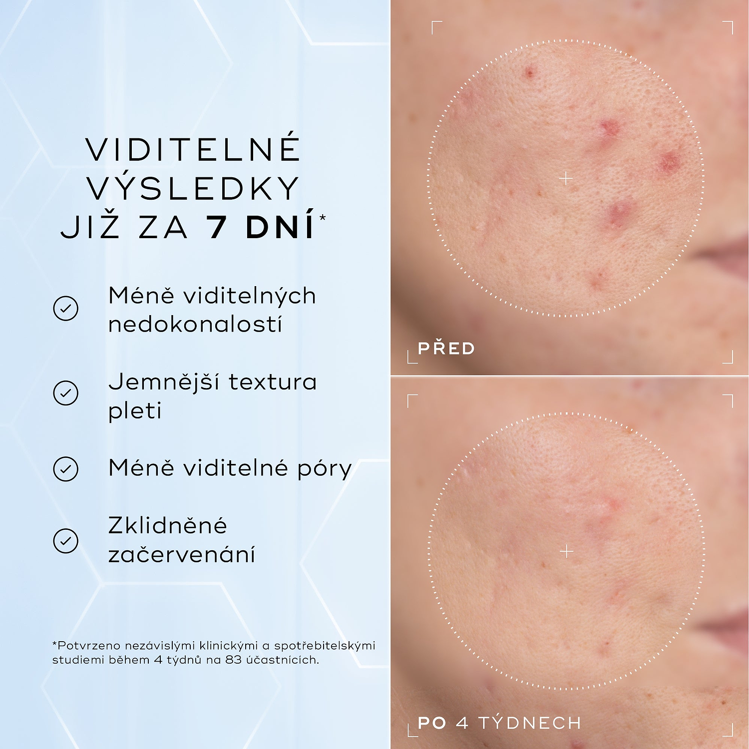 Detailní snímky tváře „Před“ a „Po 4 týdnech“ vedle sebe zobrazují pleť se zarudnutím a nerovnoměrnou texturou.
Text pod obrázkem uvádí:
„Klinicky prokázáno, že viditelně redukuje zarudnutí a zlepšuje zdraví kožní bariéry.“*