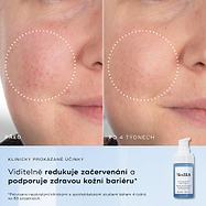 Rozdělený obrázek zobrazuje detailní záběr textury pleti označený „Před“ a „Po 4 týdnech“, který zdůrazňuje viditelné zlepšení.Text vlevo uvádí následující benefity:
Redukce nedokonalostí pleti
Zlepšení textury pleti
Zmenšení viditelnosti pórů
Zklidnění viditelného zarudnutí