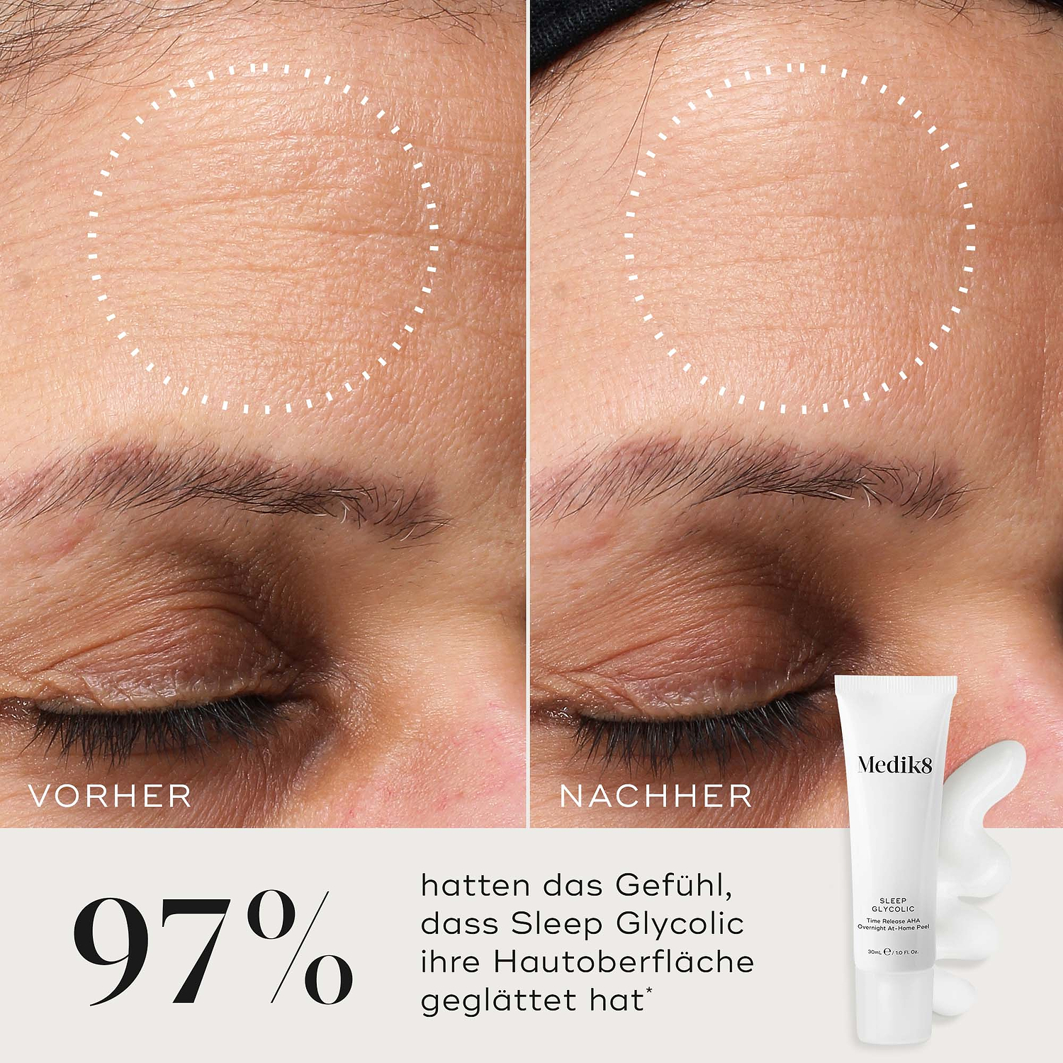 Nahaufnahme der Stirn einer Teilnehmerin vor und nach der Anwendung, die eine sichtbar glattere Hauttextur und ein verfeinertes Erscheinungsbild zeigt. Die Medik8 Sleep Glycolic-Tube und ein Strich der weißen Creme sind in der Ecke vor neutralem Hintergrund zu sehen. Der Text hebt hervor: „97 % empfanden, dass Sleep Glycolic ihre Hautoberfläche glättete.“*