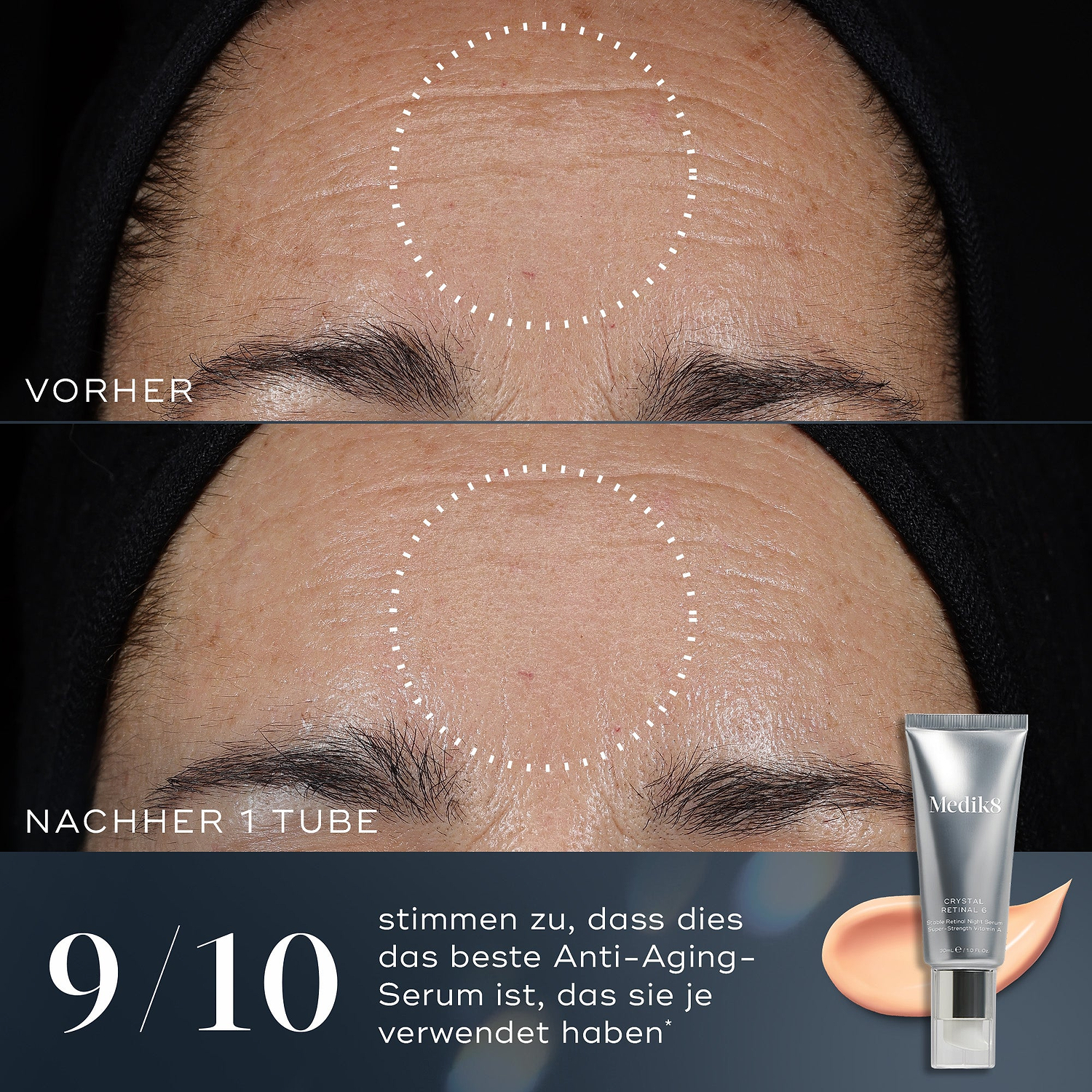  Image avant et après d'un front montrant une réduction des rides après l'utilisation de Medik8 Crystal Retinal. 