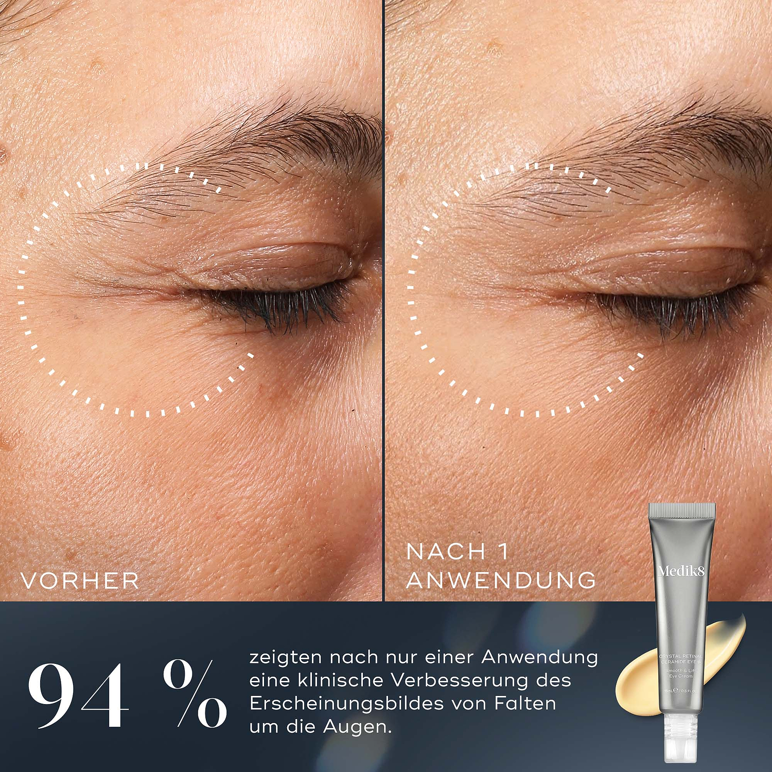 Ein Vorher-Nachher-Vergleich des Augenbereichs einer Person zeigt eine Verbesserung des Erscheinungsbilds von Falten um die Augen nach nur einer Anwendung. Unter den Bildern heißt es, dass 94 % eine klinische Verbesserung des Faltenbildes um die Augen nach nur einer Anwendung zeigten.