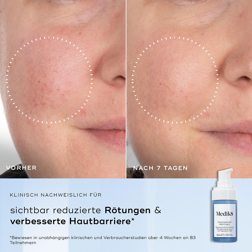 Nebeneinander angeordnete Nahaufnahmen einer Wange mit Rötungen und ungleichmäßiger Textur, gekennzeichnet als Vorher und Nach 4 Wochen. Der Text darunter lautet Klinisch erwiesen, dass sichtbare Rötungen reduziert und die Hautbarrieregesundheit verbessert werden.