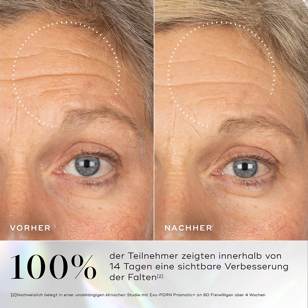 Vorher-Nachher-Bilder der Haut mit sichtbaren Fältchen im Augenbereich, deren Verbesserung nach der Anwendung des Medik8 Exo-PDRN Prismatic+ Serums hervorgehoben wird.