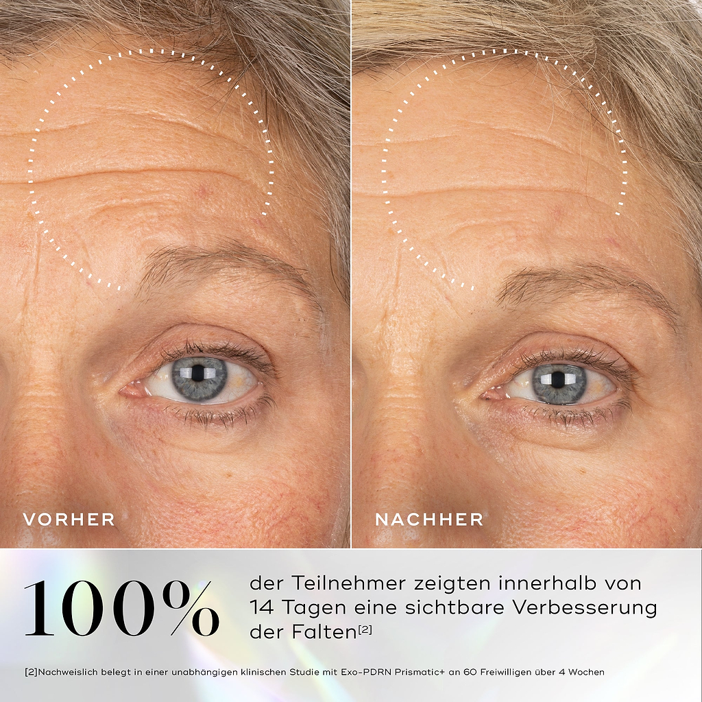 Vorher-Nachher-Bilder der Haut mit sichtbaren Fältchen im Augenbereich, deren Verbesserung nach der Anwendung des Medik8 Exo-PDRN Prismatic+ Serums hervorgehoben wird.