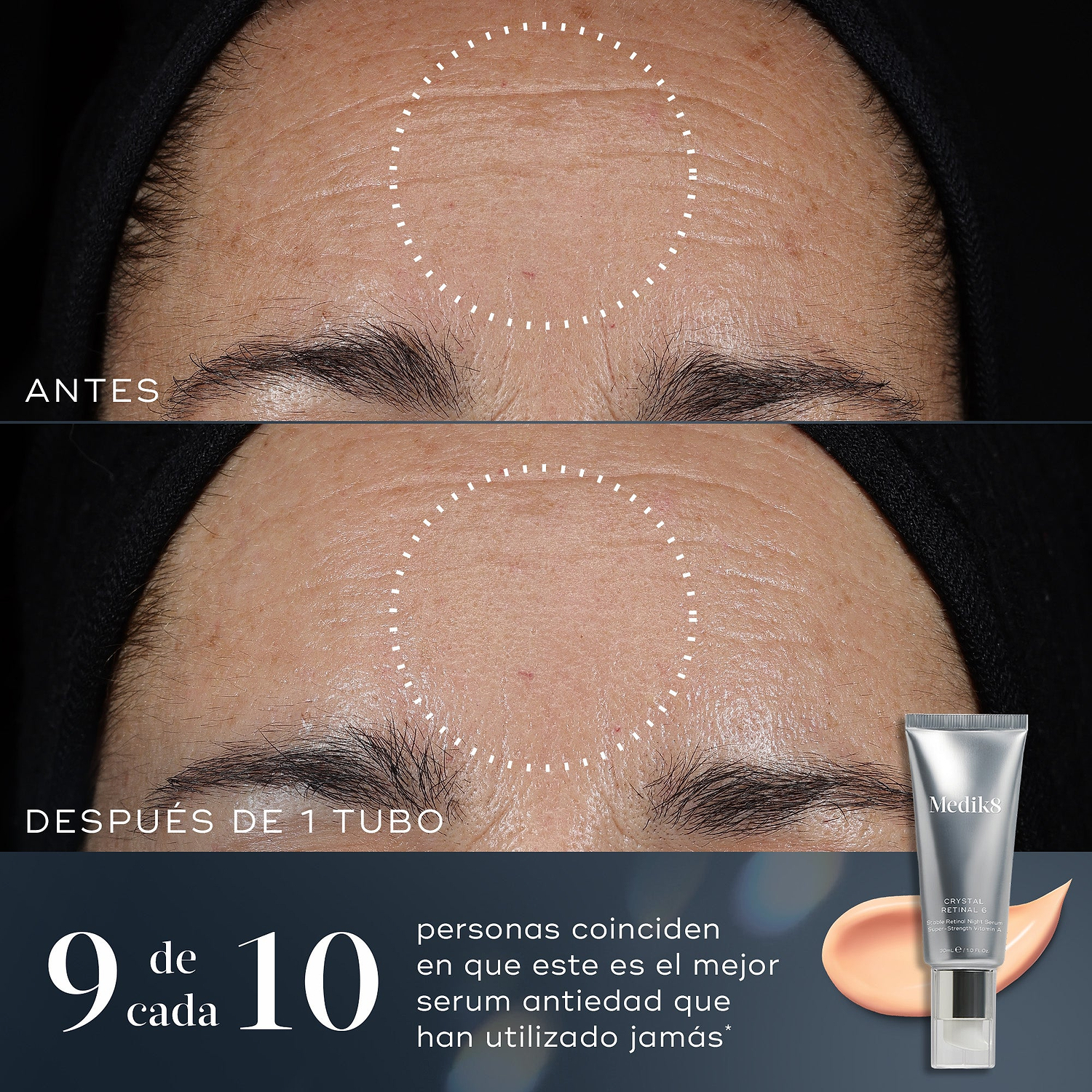 9/10 – Comparación de antes y después de la frente de una persona que muestra una mejora visible en líneas finas y arrugas tras utilizar un tubo de Crystal Retinal. El texto indica: «9 de cada 10 están de acuerdo en que este es el mejor sérum antiedad que ha