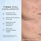 Primer plano «Antes» de la mejilla de un participante con imperfecciones visibles, enrojecimiento y poros dilatados rodeados por una línea blanca punteada. Primer plano «Después» de la mejilla del mismo participante, mostrando una reducción visible del enrojecimiento y una piel más uniforme dentro del círculo blanco punteado. Imagen dividida que muestra un primer plano de la textura de la piel etiquetada como «Antes» y «Después de 4 semanas», destacando las mejoras. El texto a la izquierda enumera los benef