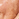 Hyperpigmentation