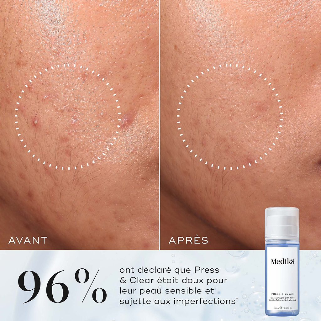 Comparaison côte à côte étiquetée Avant et Après montrant une réduction des rougeurs et une peau plus nette à l’intérieur d’un cercle pointillé. Le texte indique 100% ont montré une amélioration clinique de la fonction barrière sur leur peau sensible et sujette aux imperfections*.