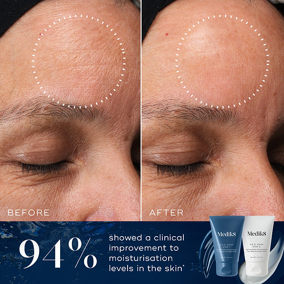A before and after close-up comparison of a forehead, showing visibly smoother and more hydrated-looking skin in the circled area on the "After" side compared to the "Before" side. Text below states "94% showed a clinical improvement to moisturisation levels in the skin*". Tubes of Medik8 H.E.O. Mask Step 1 and Step 2 are displayed in the corner against a blue background.-hover-41