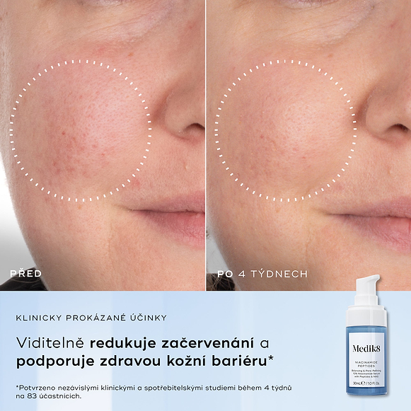 Rozdělený obrázek zobrazuje detailní záběr textury pleti označený „Před“ a „Po 4 týdnech“, který zdůrazňuje viditelné zlepšení.Text vlevo uvádí následující benefity:
Redukce nedokonalostí pleti
Zlepšení textury pleti
Zmenšení viditelnosti pórů
Zklidnění viditelného zarudnutí-hover-16