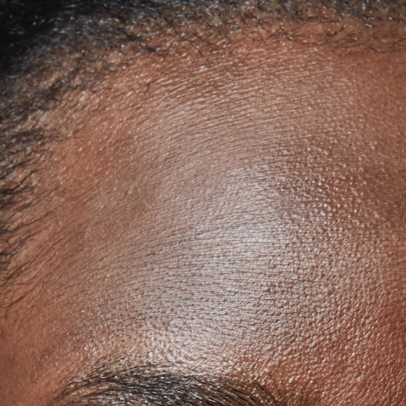 A close-up photograph illustrating the textured appearance of dry and dehydrated skin on a person's forehead. Below the image, clear text identifies this skin concern as 'Dry & Dehydrated Skin'.