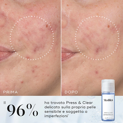 Confronto prima e dopo della guancia di una partecipante nel tempo, accanto a un flacone Medik8 Press & Clear. Il testo in italiano evidenzia che il 96% ha trovato Press & Clear delicato sulla propria pelle sensibile e soggetta a imperfezioni.