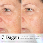 Voor- en nafoto’s van de huid met zichtbare rimpels rond de oogzone, met verbetering na gebruik van Medik8 Exo-PDRN Prismatic+ serum.