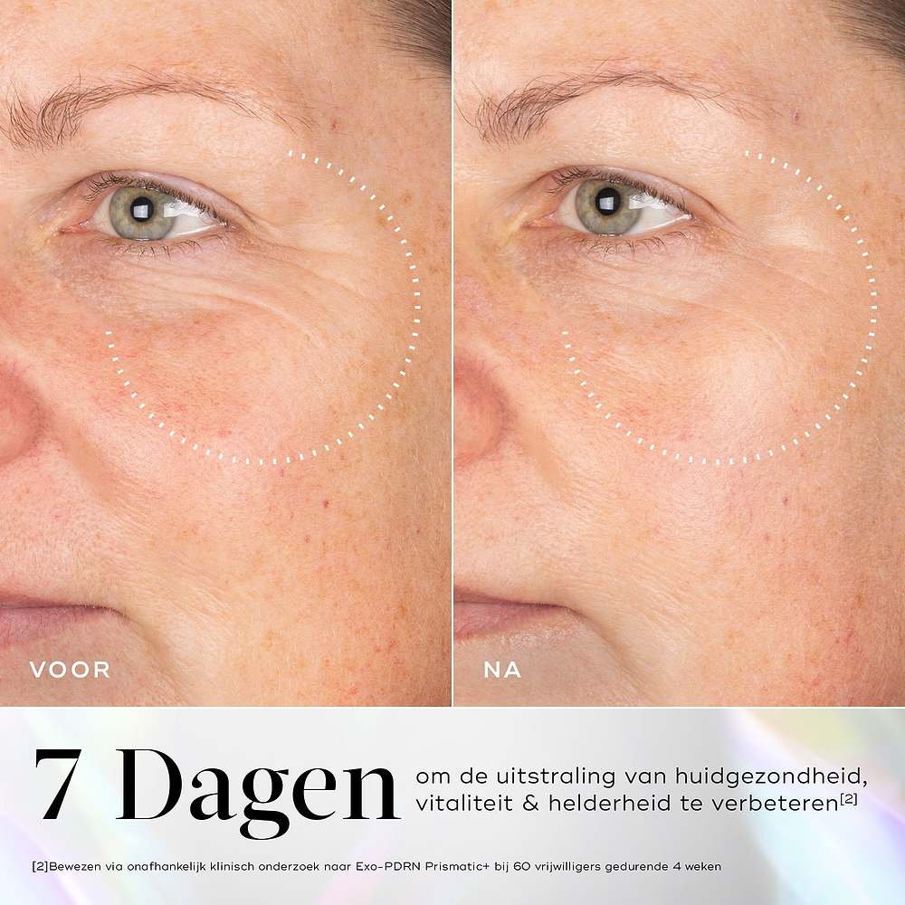 Voor- en nafoto’s van de huid met zichtbare rimpels rond de oogzone, met verbetering na gebruik van Medik8 Exo-PDRN Prismatic+ serum.