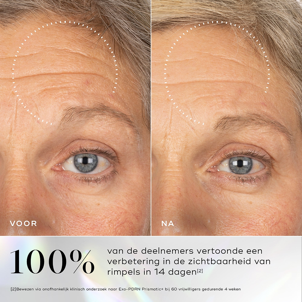Voor- en na vergelijking die een zichtbare verbetering in huidtextuur en gladheid toont na langdurig gebruik van Medik8 Exo-PDRN Prismatic+.