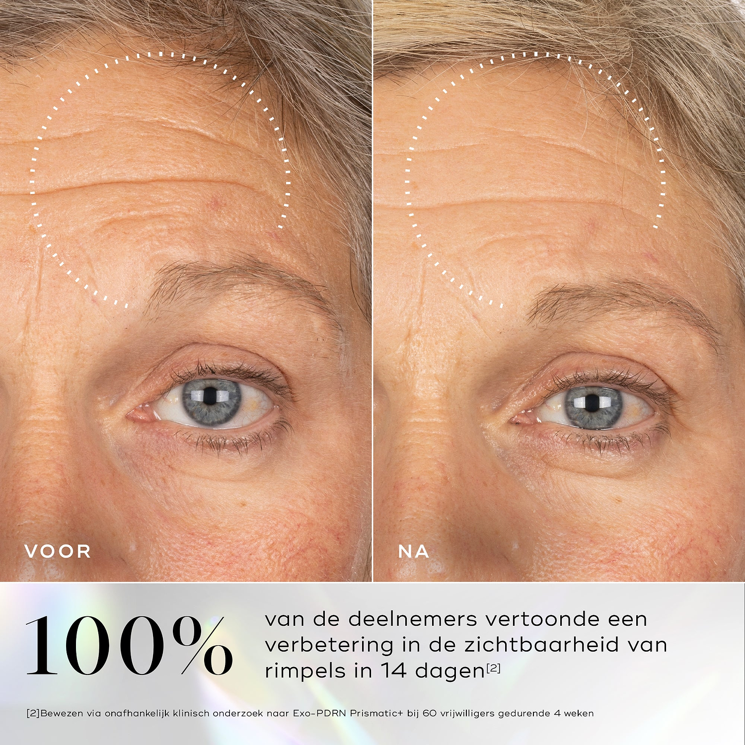 Voor- en na vergelijking die een zichtbare verbetering in huidtextuur en gladheid toont na langdurig gebruik van Medik8 Exo-PDRN Prismatic+.