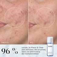 Porównanie obok siebie oznaczone „Before” i „After”, przedstawiające zmniejszenie zaczerwienienia oraz bardziej czystą skórę w obrębie przerywanego okręgu. Tekst informuje, że u 96% osób zaobserwowano klinicznie potwierdzoną poprawę funkcji bariery skórnej na skórze wrażliwej i skłonnej do niedoskonałości*.
