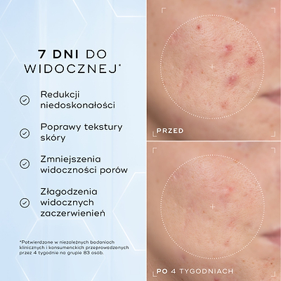 Zbliżenia policzka z zaczerwienieniem i problemami z teksturą skóry – zdjęcia „przed” i „po” 4 tygodniach, przedstawione obok siebie. Poniższy tekst zawiera informację: „Klinicznie udowodniono, że produkt widocznie zmniejsza zaczerwienienia i poprawia kondycję bariery skórnej*”.