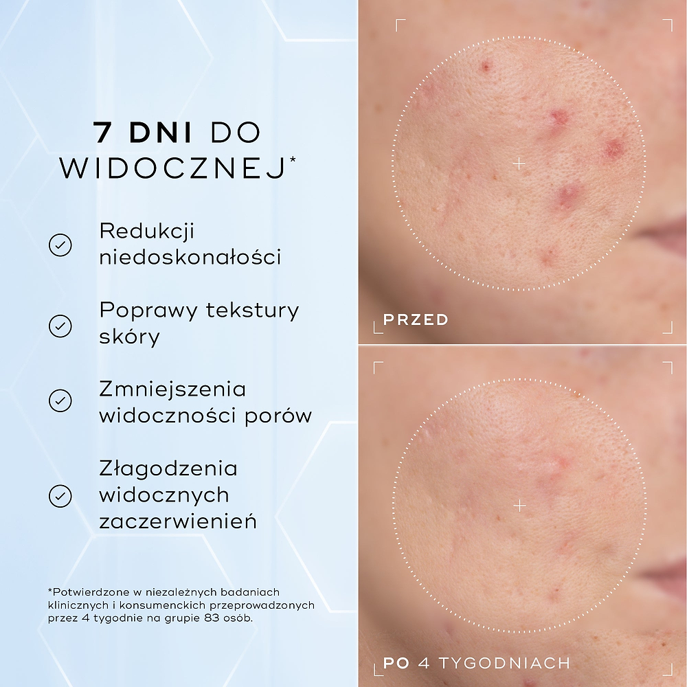 Zbliżenia policzka z zaczerwienieniem i problemami z teksturą skóry – zdjęcia „przed” i „po” 4 tygodniach, przedstawione obok siebie. Poniższy tekst zawiera informację: „Klinicznie udowodniono, że produkt widocznie zmniejsza zaczerwienienia i poprawia kondycję bariery skórnej*”.