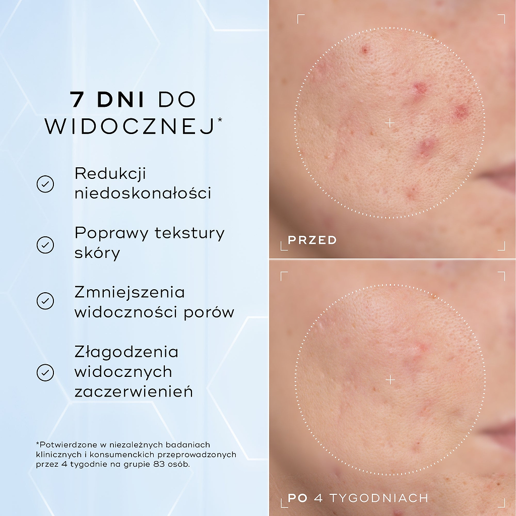 Zbliżenia policzka z zaczerwienieniem i problemami z teksturą skóry – zdjęcia „przed” i „po” 4 tygodniach, przedstawione obok siebie. Poniższy tekst zawiera informację: „Klinicznie udowodniono, że produkt widocznie zmniejsza zaczerwienienia i poprawia kondycję bariery skórnej*”.