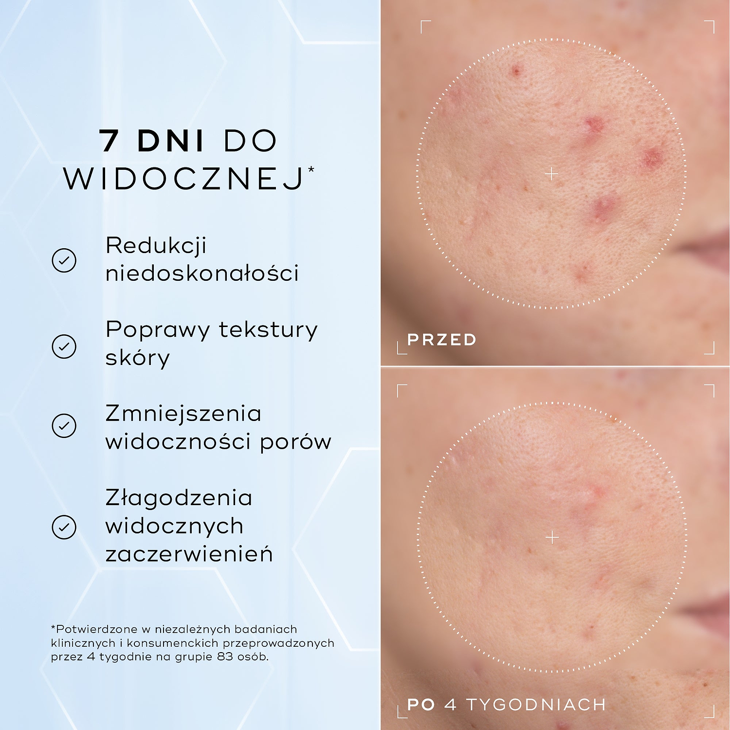 Zbliżenia policzka z zaczerwienieniem i problemami z teksturą skóry – zdjęcia „przed” i „po” 4 tygodniach, przedstawione obok siebie. Poniższy tekst zawiera informację: „Klinicznie udowodniono, że produkt widocznie zmniejsza zaczerwienienia i poprawia kondycję bariery skórnej*”.