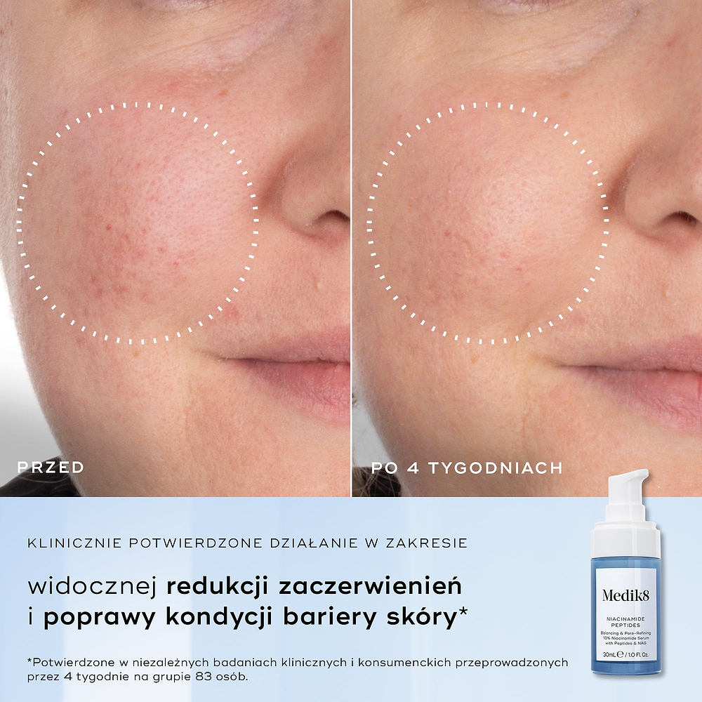 Podzielone zdjęcie przedstawiające zbliżenie struktury skóry z podpisami „Przed” i „Po 4 tygodniach”, podkreślające poprawę stanu skóry. Tekst po lewej stronie wymienia korzyści: zmniejszenie niedoskonałości, poprawa struktury skóry, zmniejszenie rozmiaru porów oraz złagodzenie widocznych zaczerwienień.