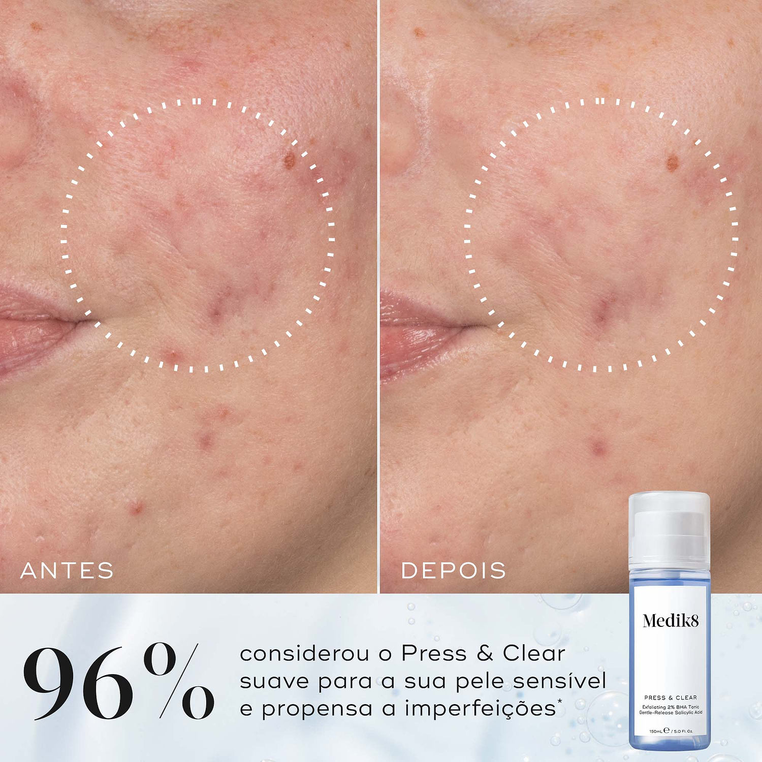Comparação de antes e depois de uma bochecha mostrando uma textura visivelmente mais suave, destacada por um círculo pontilhado. Abaixo, ao lado de um frasco de Press & Glow, o texto afirma que 97% concorda que a pele parecia mais suave após a utilização.
