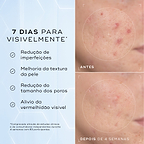 Comparação antes e depois da bochecha com imperfeições de uma participante ao longo de 4 semanas contra um fundo azul claro. O texto em português lista resultados visíveis em 7 dias: redução de imperfeições, melhoria da textura da pele, redução do tamanho dos poros e alívio da vermelhidão visível.