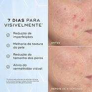 Comparação antes e depois da bochecha com imperfeições de uma participante ao longo de 4 semanas contra um fundo azul claro. O texto em português lista resultados visíveis em 7 dias: redução de imperfeições, melhoria da textura da pele, redução do tamanho dos poros e alívio da vermelhidão visível.