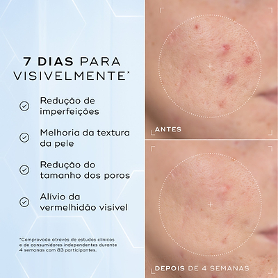 Comparação antes e depois da bochecha com imperfeições de uma participante ao longo de 4 semanas contra um fundo azul claro. O texto em português lista resultados visíveis em 7 dias: redução de imperfeições, melhoria da textura da pele, redução do tamanho dos poros e alívio da vermelhidão visível.