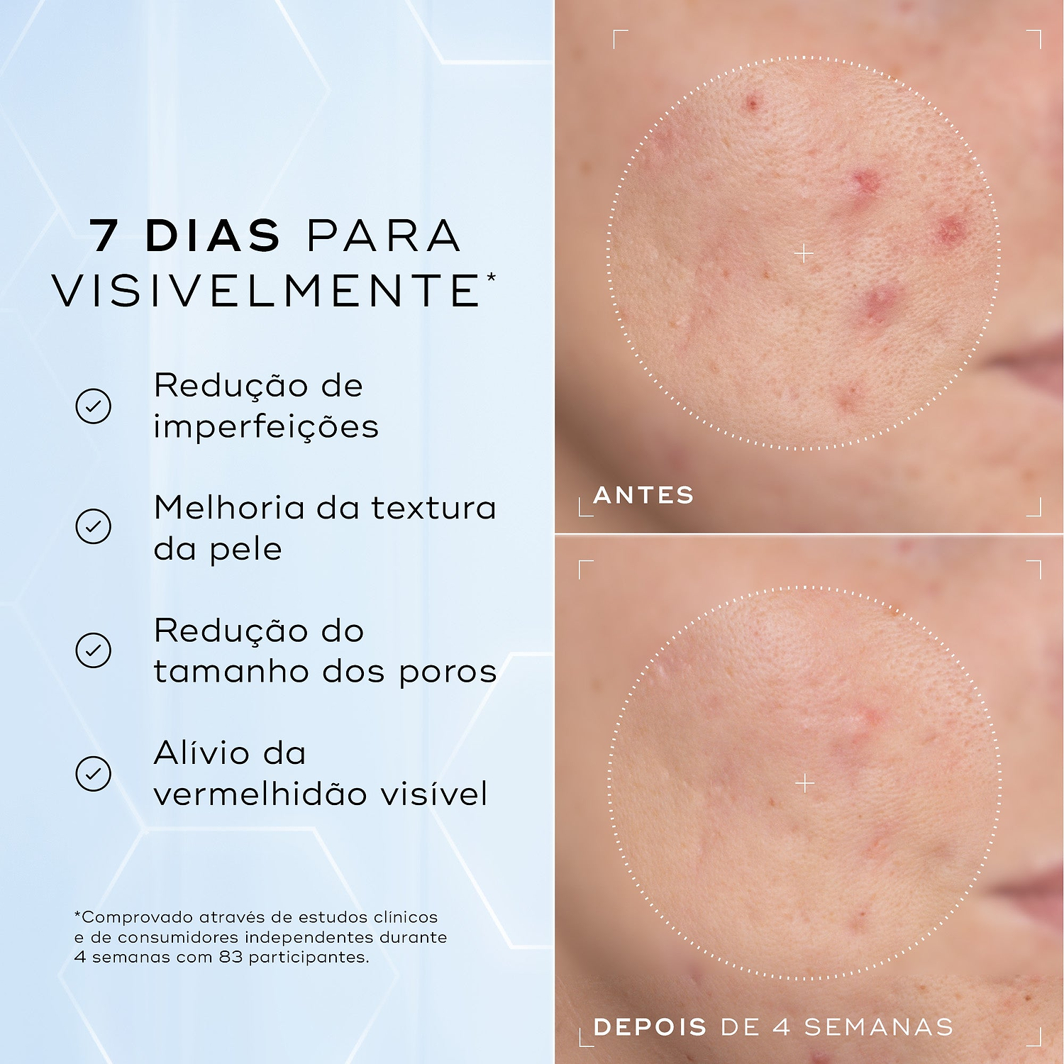 Comparação antes e depois da bochecha com imperfeições de uma participante ao longo de 4 semanas contra um fundo azul claro. O texto em português lista resultados visíveis em 7 dias: redução de imperfeições, melhoria da textura da pele, redução do tamanho dos poros e alívio da vermelhidão visível.