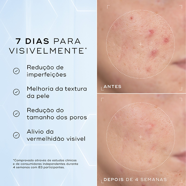 Comparação antes e depois da bochecha com imperfeições de uma participante ao longo de 4 semanas contra um fundo azul claro. O texto em português lista resultados visíveis em 7 dias: redução de imperfeições, melhoria da textura da pele, redução do tamanho dos poros e alívio da vermelhidão visível.