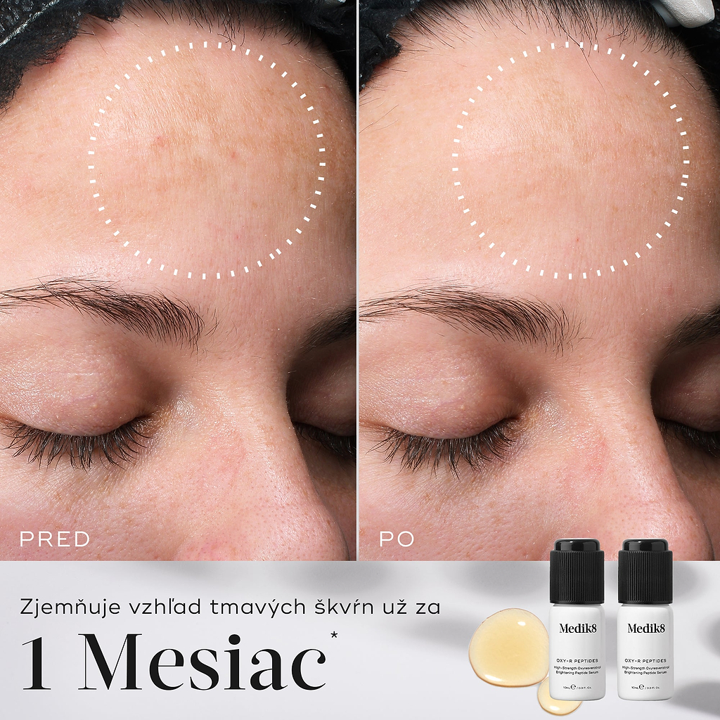 Porovnanie čela pred a po ošetrení ukazuje vyblednuté tmavé škvrny. Biele bodkované kruhy označujú miesta, kde došlo k zmene. Pod obrázkami je uvedený text: „Zmierňuje výskyt tmavých škvŕn už za 1 mesiac.“ 