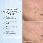Porovnanie detailných záberov na líce pred aplikáciou a po 4 týždňoch zobrazuje viditeľné zmiernenie začervenania a nedokonalostí textúry, čo dopĺňa text pod nimi s informáciou, že produkt je klinicky overený na redukciu viditeľného začervenania a zlepšenie zdravia kožnej bariéry.