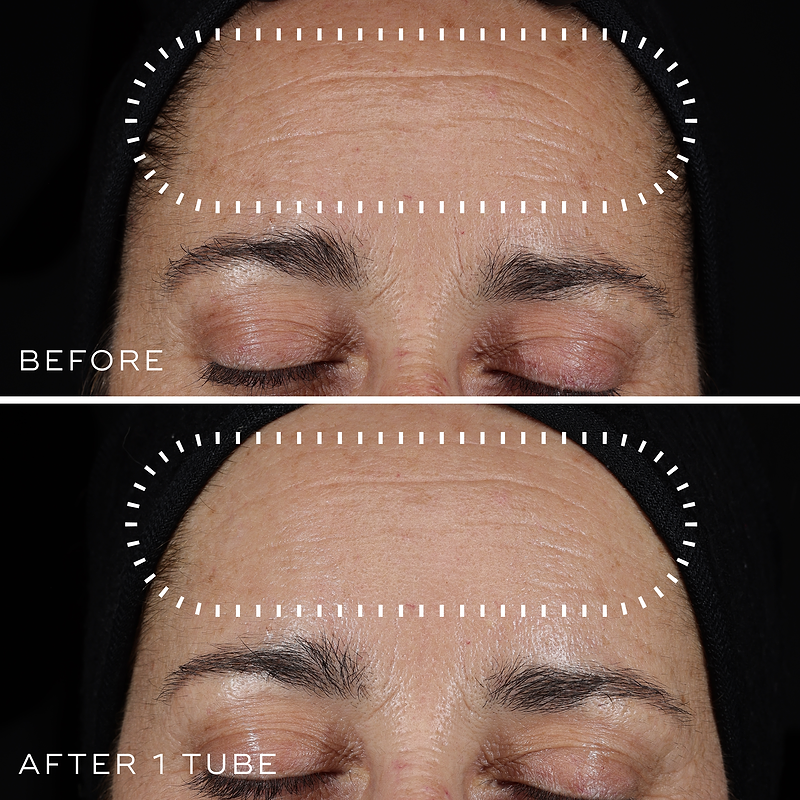 glutathione pills before and after reddit My 21 day oral results (Before & After) : r/IndianSkincareAddicts Petunia SkinCare 1.0mm Derma Roller,