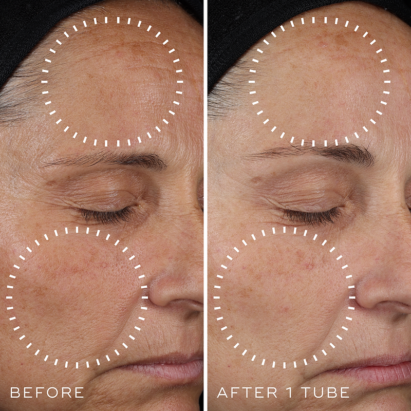 now glutathione before and after result.You can clearly see the difference. To book your slot or for any kind of info call us at +880 13 1186 3562 Or visit us at Luxe glutathione skin before after Glutathione