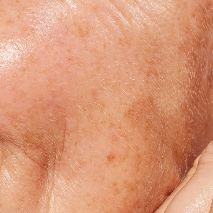 A detailed close-up photograph illustrating visible dark spots and uneven skin tone across a person’s cheek. Below the image, clear text identifies this skin concern as 'Hyperpigmentation'.
