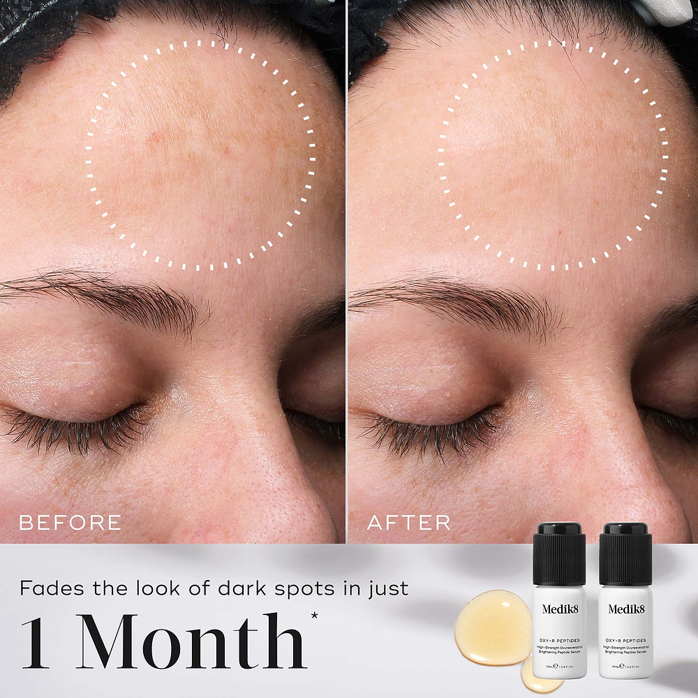 A before-and-after comparison of a person's forehead shows faded dark spots. Dotted white circles highlight the areas of change. Below the images, text states Fades the look of dark spots in just 1 Month. 